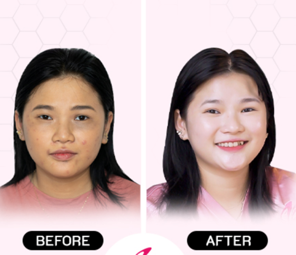 Liệu trình Glass Skin với Trứng cá Tuyết - Junhee Beauty Center